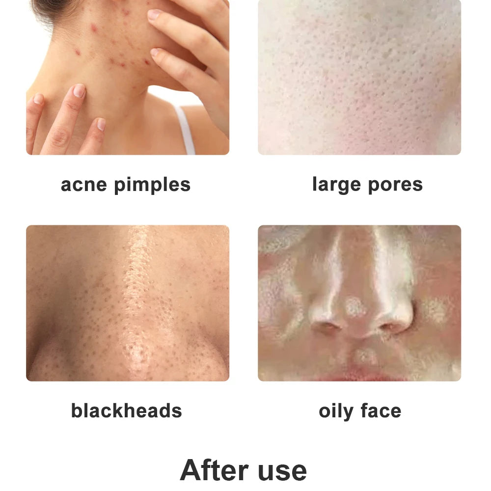 Wholesale Facial Microdermabrasion Machine Diamond Tip Dermabrasion Devices Skin Exfoliation Vacumtherapy Wrinkle Beauty Tool