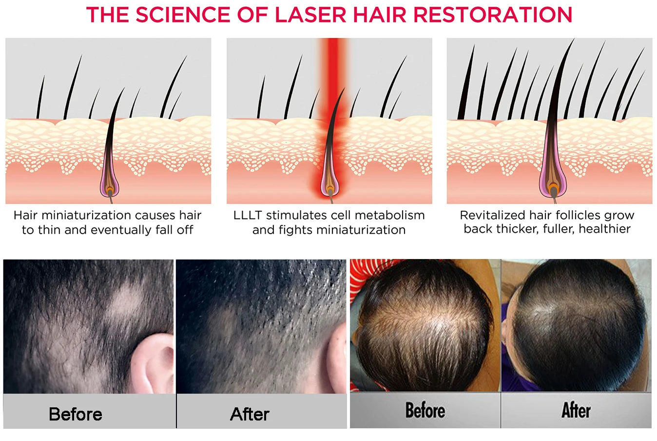 Red Light Laser Hair Growth Helmet for Anti hair loss laser hair regrowth therapy